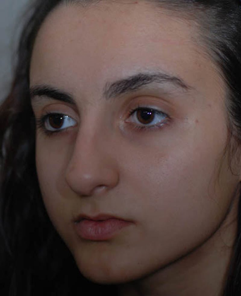 Rhinoplasty Before & After Gallery - Patient 12974017 - Image 7