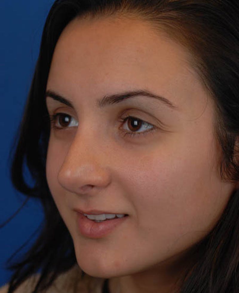 Rhinoplasty Before & After Gallery - Patient 12974017 - Image 8