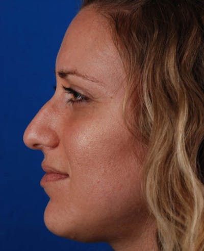 Rhinoplasty Before & After Gallery - Patient 12974020 - Image 1