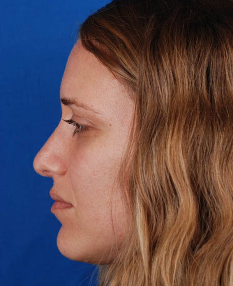 Rhinoplasty Before & After Gallery - Patient 12974020 - Image 2