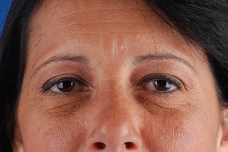 Quad Blepharoplasty Before & After Gallery - Patient 12974018 - Image 1