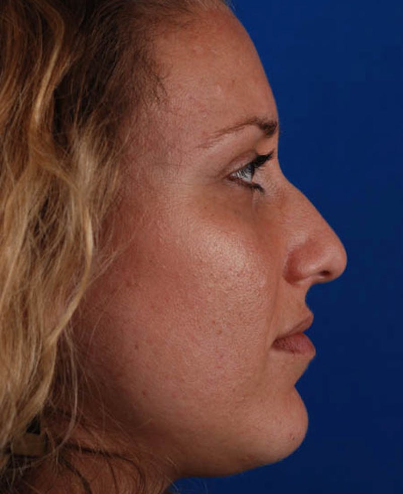 Rhinoplasty Before & After Gallery - Patient 12974020 - Image 3