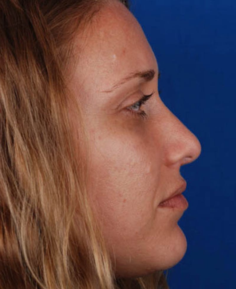 Rhinoplasty Before & After Gallery - Patient 12974020 - Image 4