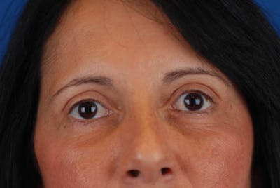Quad Blepharoplasty Before & After Gallery - Patient 12974018 - Image 2