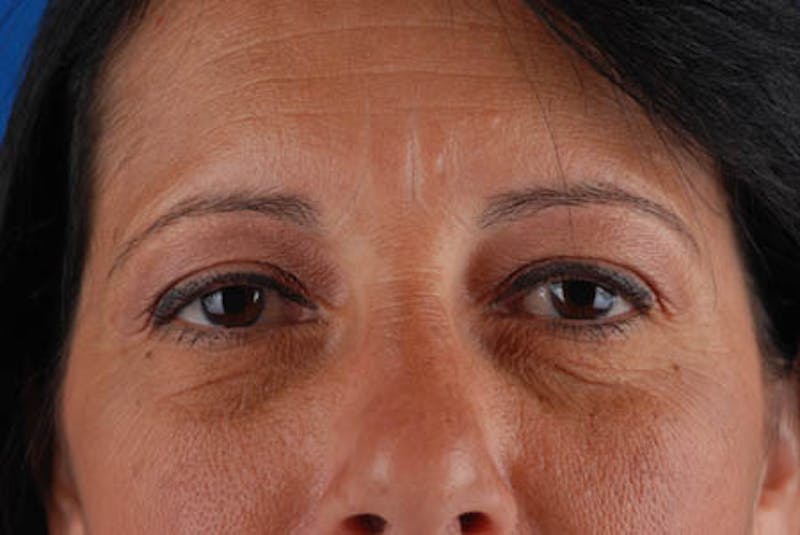 Quad Blepharoplasty Before & After Gallery - Patient 12974018 - Image 3