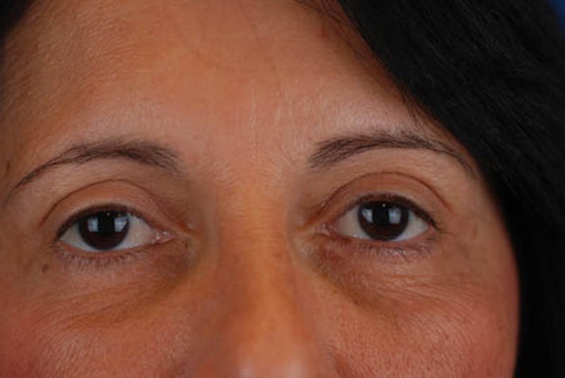 Quad Blepharoplasty Before & After Gallery - Patient 12974018 - Image 4