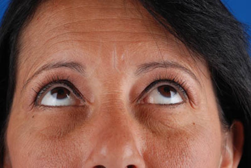 Quad Blepharoplasty Before & After Gallery - Patient 12974018 - Image 5