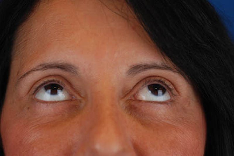 Quad Blepharoplasty Before & After Gallery - Patient 12974018 - Image 6