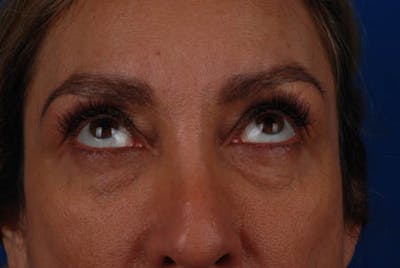 Lower Blepharoplasty Before & After Gallery - Patient 12974019 - Image 1