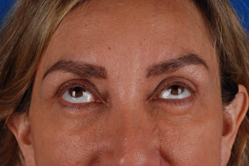 Lower Blepharoplasty Before & After Gallery - Patient 12974019 - Image 2