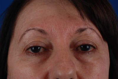 Quad Blepharoplasty Before & After Gallery - Patient 12974021 - Image 1