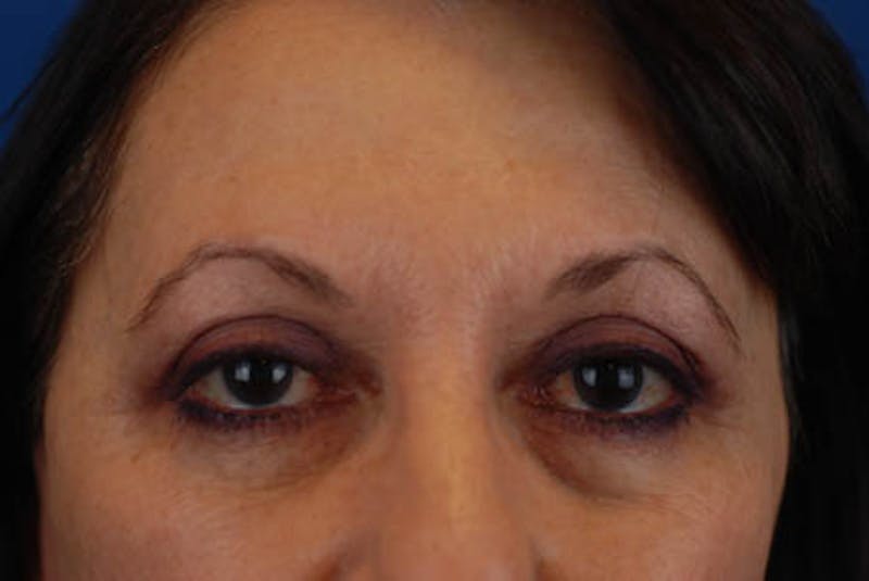 Quad Blepharoplasty Before & After Gallery - Patient 12974021 - Image 2