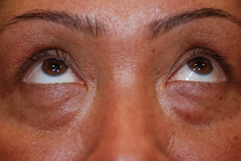 Lower Blepharoplasty Gallery - Patient 12974032 - Image 1