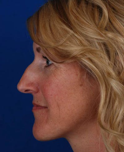 Rhinoplasty Before & After Gallery - Patient 12974036 - Image 1