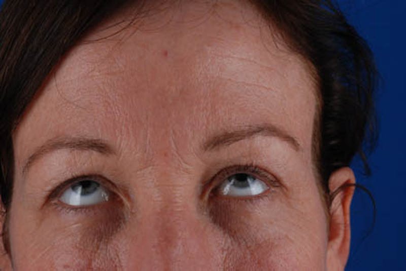 Quad Blepharoplasty Before & After Gallery - Patient 12974031 - Image 1