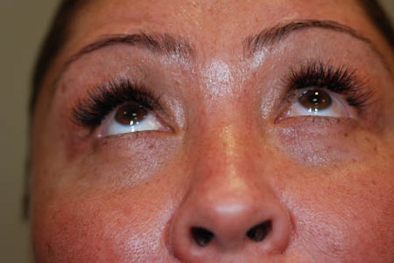 Lower Blepharoplasty Before & After Gallery - Patient 12974032 - Image 2