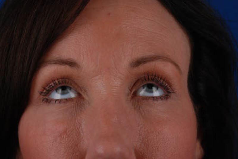 Quad Blepharoplasty Before & After Gallery - Patient 12974031 - Image 4