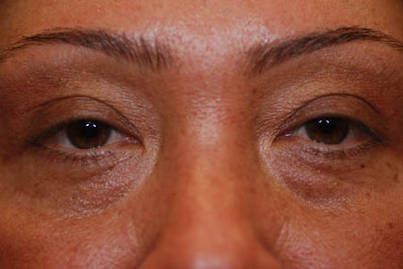 Lower Blepharoplasty Gallery - Patient 12974032 - Image 3