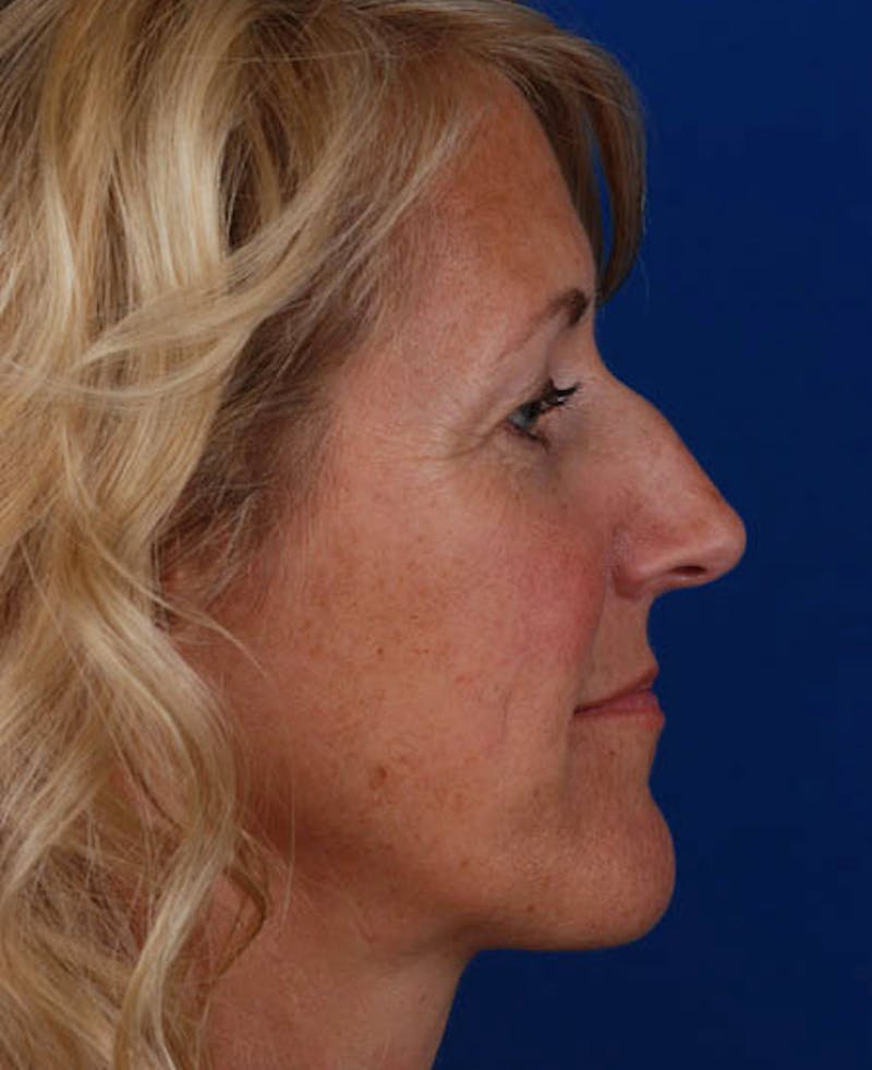 Rhinoplasty Before & After Gallery - Patient 12974036 - Image 3