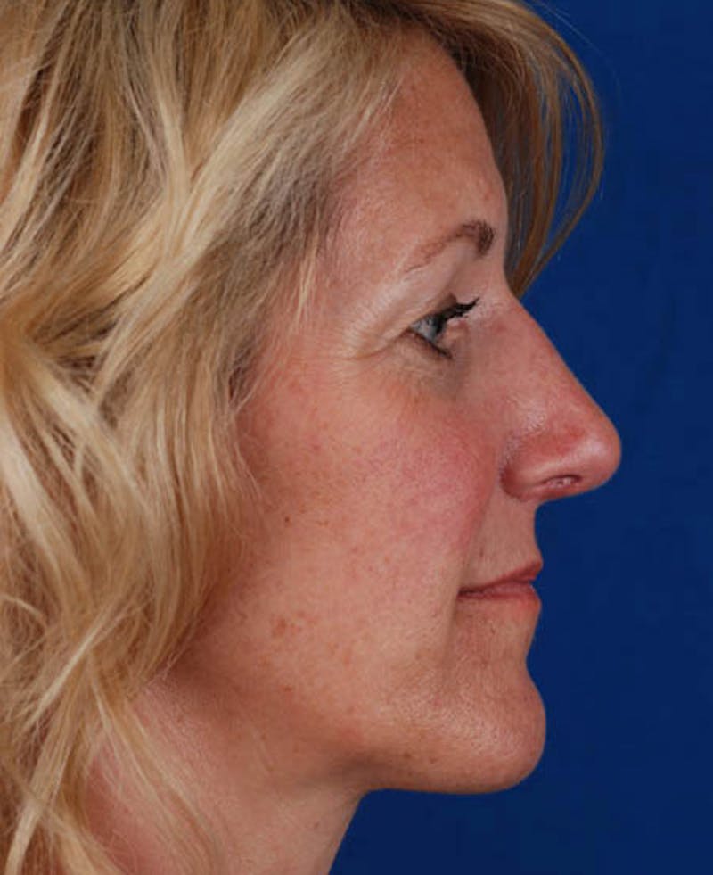 Rhinoplasty Before & After Gallery - Patient 12974036 - Image 4