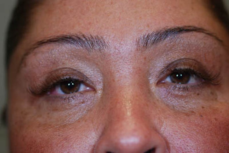 Lower Blepharoplasty Before & After Gallery - Patient 12974032 - Image 4