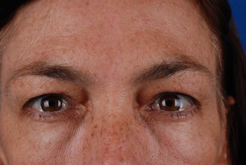 Quad Blepharoplasty Before & After Gallery - Patient 12974033 - Image 1