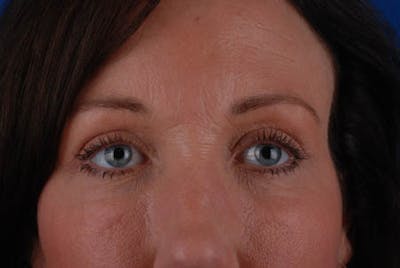 Lower Blepharoplasty Before & After Gallery - Patient 12974034 - Image 2