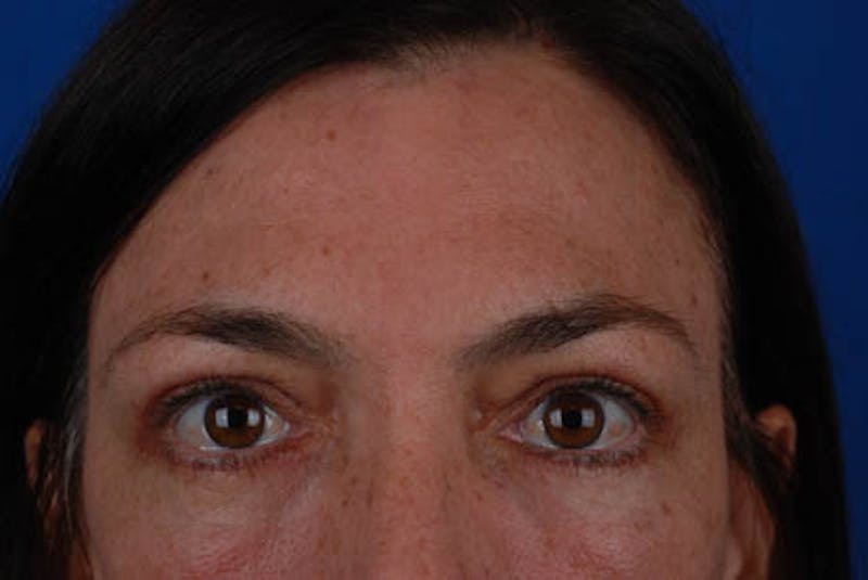 Quad Blepharoplasty Before & After Gallery - Patient 12974033 - Image 2