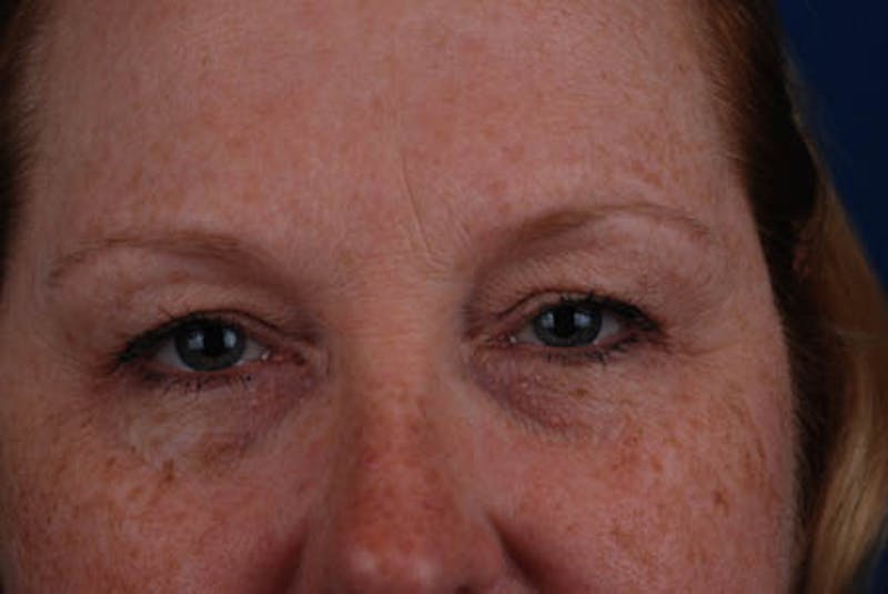 Quad Blepharoplasty Before & After Gallery - Patient 12974035 - Image 1