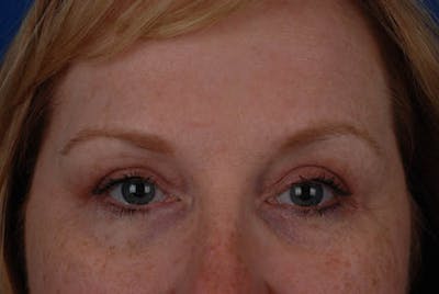 Quad Blepharoplasty Before & After Gallery - Patient 12974035 - Image 2