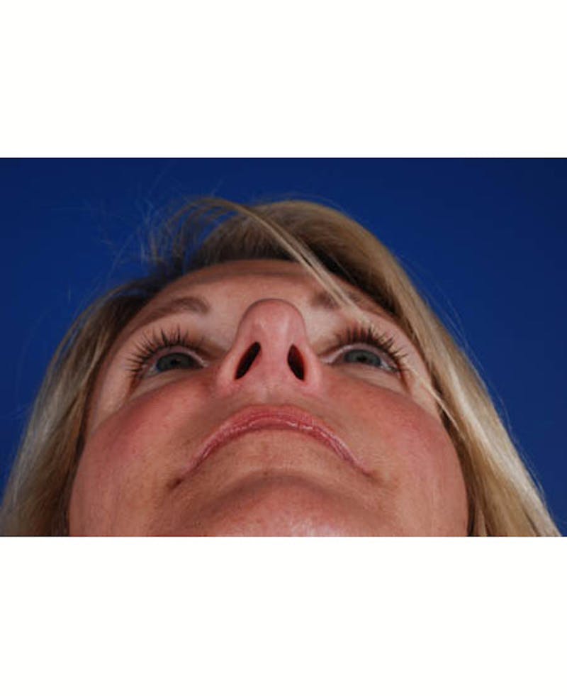 Rhinoplasty Before & After Gallery - Patient 12974036 - Image 10