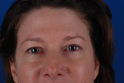 Upper Blepharoplasty Before & After Gallery - Patient 12974037 - Image 1