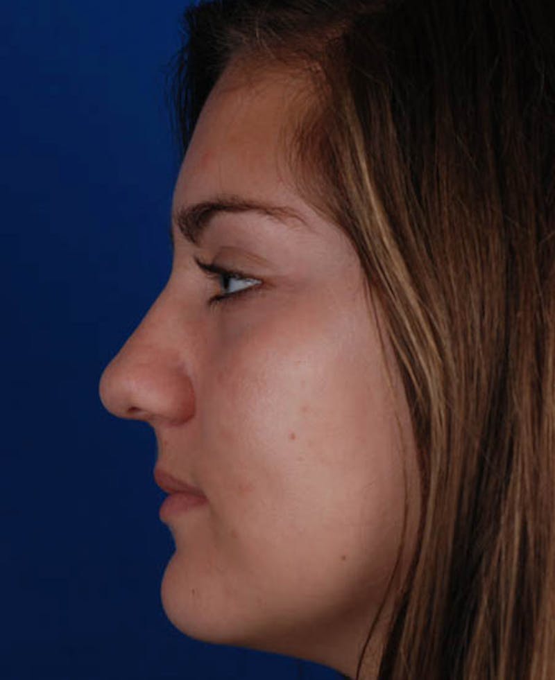Rhinoplasty Before & After Gallery - Patient 12974041 - Image 1