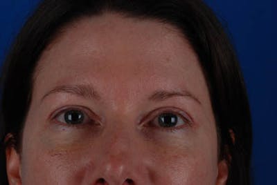 Upper Blepharoplasty Before & After Gallery - Patient 12974037 - Image 2