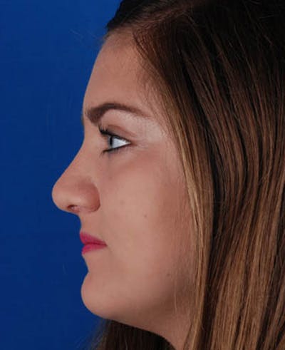 Rhinoplasty Before & After Gallery - Patient 12974041 - Image 2