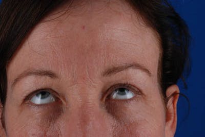 Upper Blepharoplasty Before & After Gallery - Patient 12974039 - Image 1
