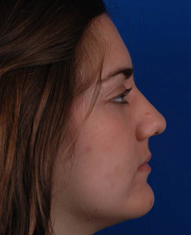 Rhinoplasty Before & After Gallery - Patient 12974041 - Image 3