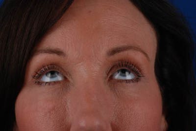 Upper Blepharoplasty Before & After Gallery - Patient 12974039 - Image 2
