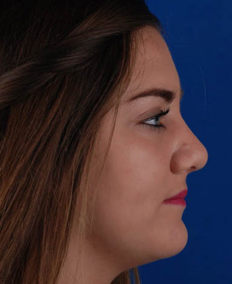 Rhinoplasty Before & After Gallery - Patient 12974041 - Image 4