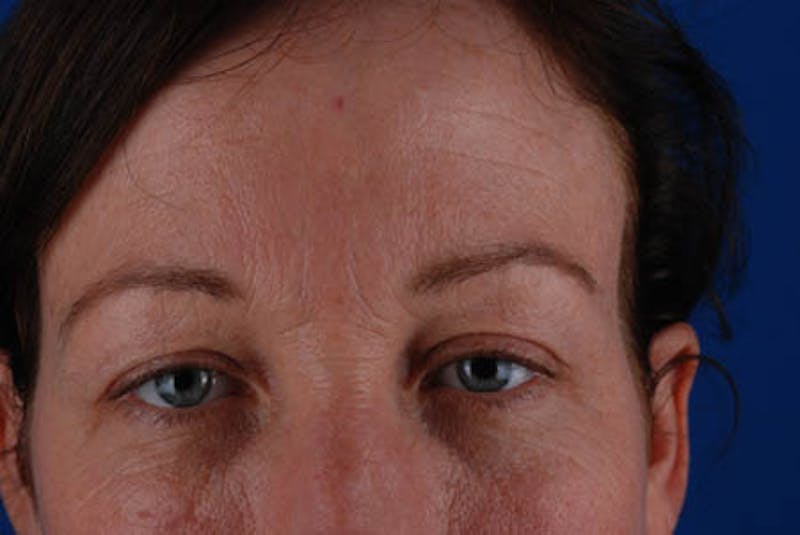 Upper Blepharoplasty Before & After Gallery - Patient 12974039 - Image 3