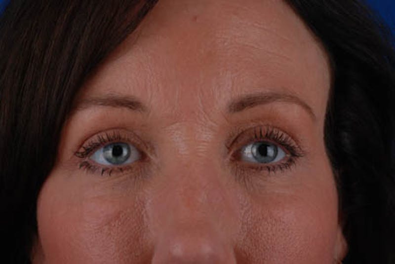 Upper Blepharoplasty Before & After Gallery - Patient 12974039 - Image 4