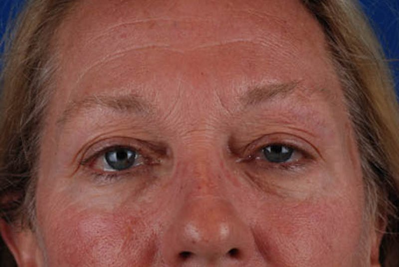 Upper Blepharoplasty Before & After Gallery - Patient 12974040 - Image 1
