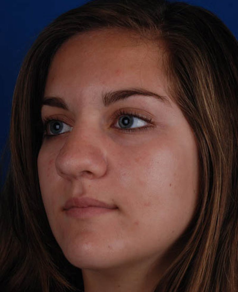 Rhinoplasty Before & After Gallery - Patient 12974041 - Image 7