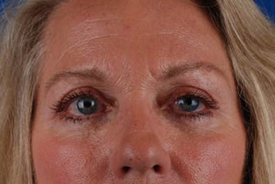 Upper Blepharoplasty Before & After Gallery - Patient 12974040 - Image 2