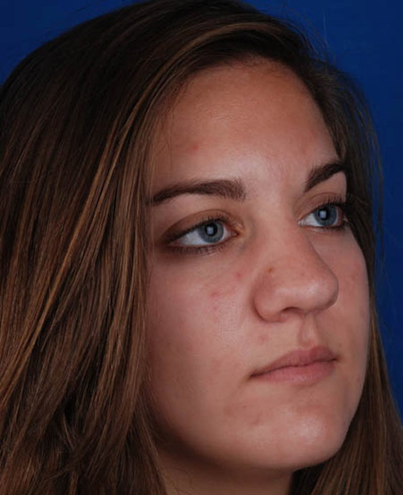 Rhinoplasty Before & After Gallery - Patient 12974041 - Image 9