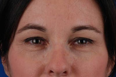Upper Blepharoplasty Before & After Gallery - Patient 12974043 - Image 1