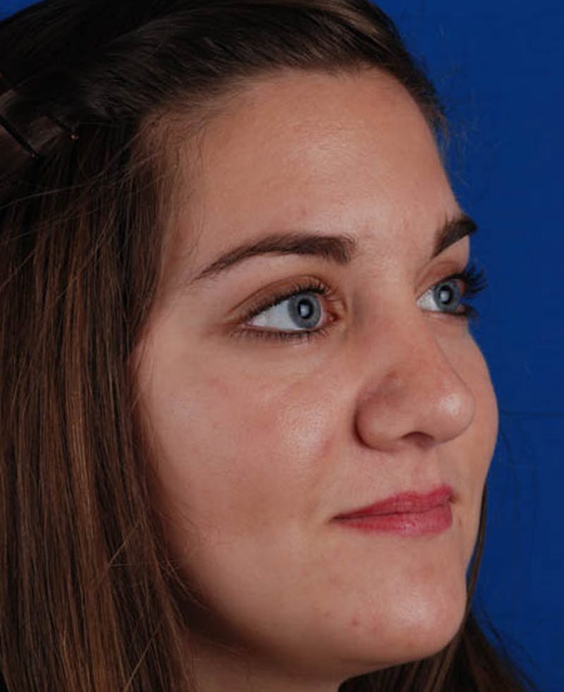 Rhinoplasty Before & After Gallery - Patient 12974041 - Image 10