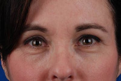 Upper Blepharoplasty Before & After Gallery - Patient 12974043 - Image 2