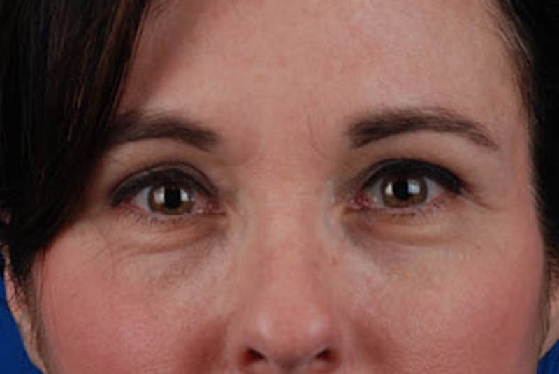 Upper Blepharoplasty Before & After Gallery - Patient 12974043 - Image 2