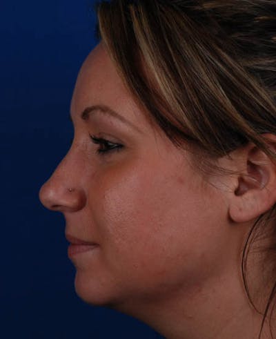 Rhinoplasty Before & After Gallery - Patient 12974047 - Image 1